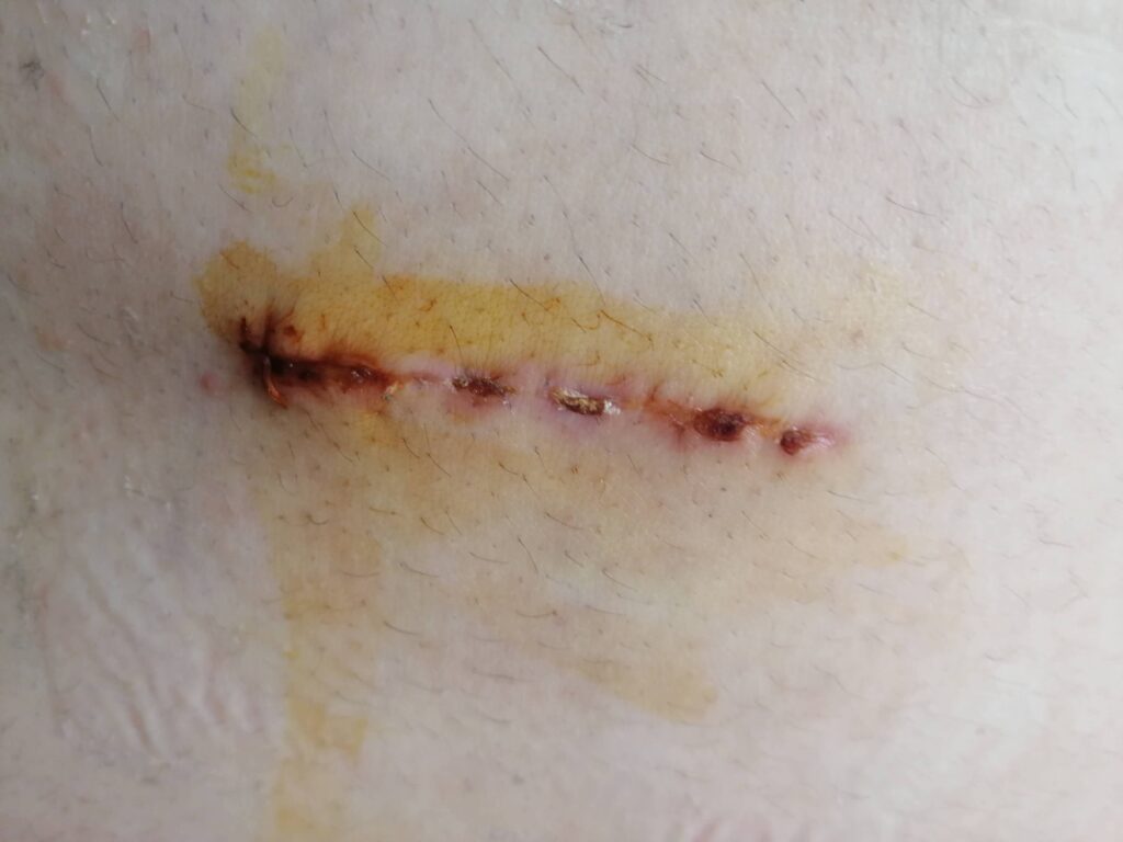 Bel fıtığı ameliyat sonrası belimin yani kesilen bölgenin görüntüsü 3