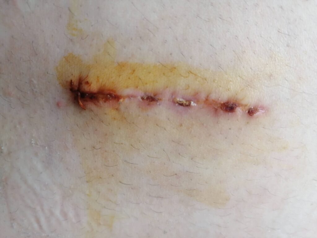 Bel fıtığı ameliyat sonrası belimin yani kesilen bölgenin görüntüsü 4